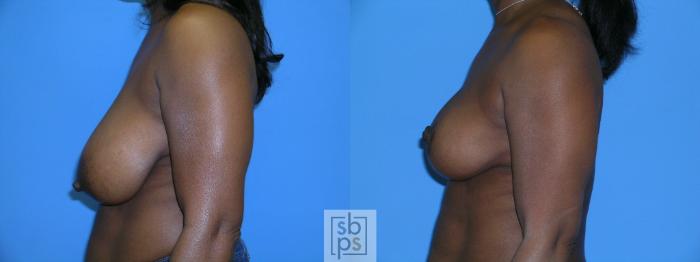Before & After Breast Reduction Case 87 View #4 View in Torrance, CA