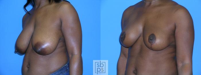 Before & After Breast Reduction Case 87 View #5 View in Torrance, CA