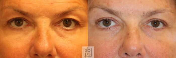 Before & After Eyelid Surgery (Blepharoplasty) Case 340 View #1 View in Torrance, CA