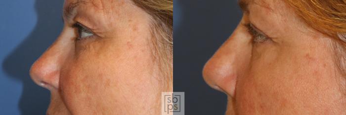 Before & After Eyelid Surgery (Blepharoplasty) Case 340 View #2 View in Torrance, CA