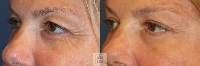 Before & After Eyelid Surgery (Blepharoplasty) Case 340 View #3 View in Torrance, CA