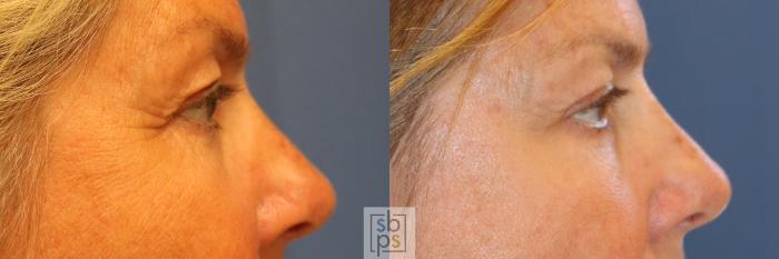 Before & After Eyelid Surgery (Blepharoplasty) Case 340 View #4 View in Torrance, CA