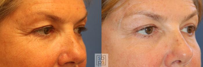 Before & After Eyelid Surgery (Blepharoplasty) Case 340 View #5 View in Torrance, CA