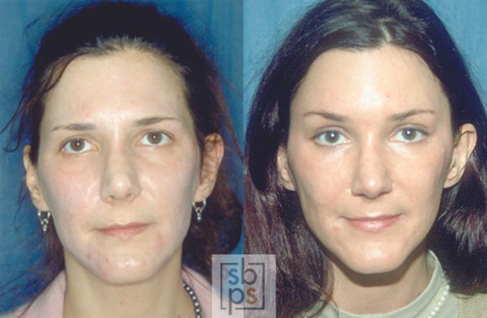 Before & After Brow Lift Case 43 View #1 View in Torrance, CA