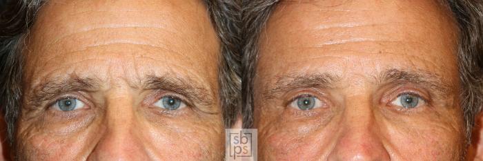 Before & After Brow Lift Case 570 Front View in Torrance, CA