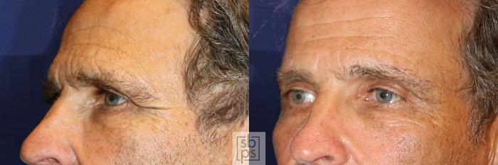 Before & After Brow Lift Case 570 Left Oblique View in Torrance, CA