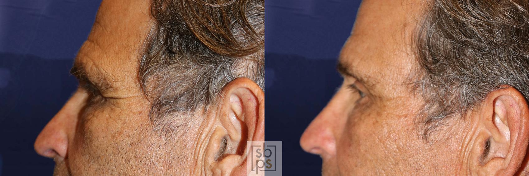Before & After Brow Lift Case 570 Left Side View in Torrance & Los Angeles, CA, CA