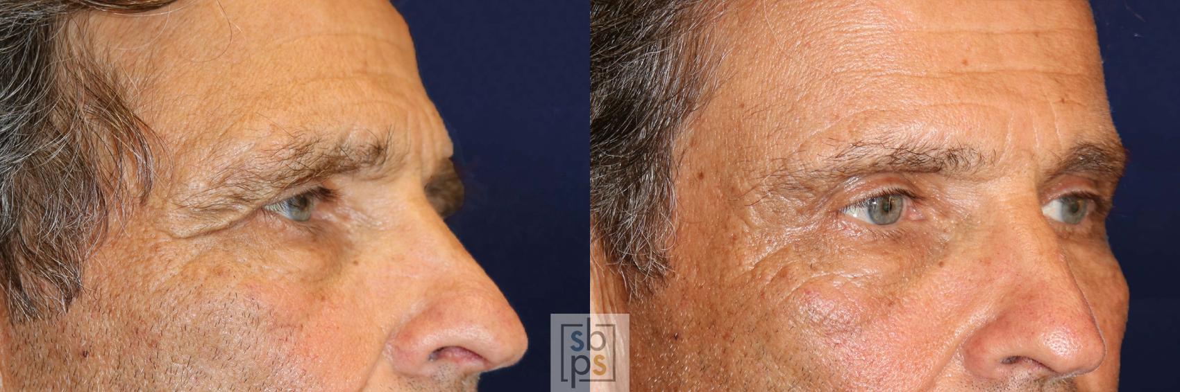 Before & After Brow Lift Case 570 Right Oblique View in Torrance & Los Angeles, CA, CA