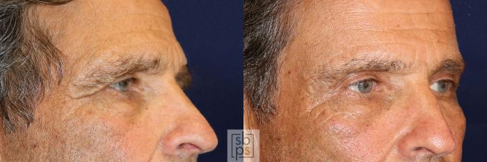 Before & After Brow Lift Case 570 Right Oblique View in Torrance, CA