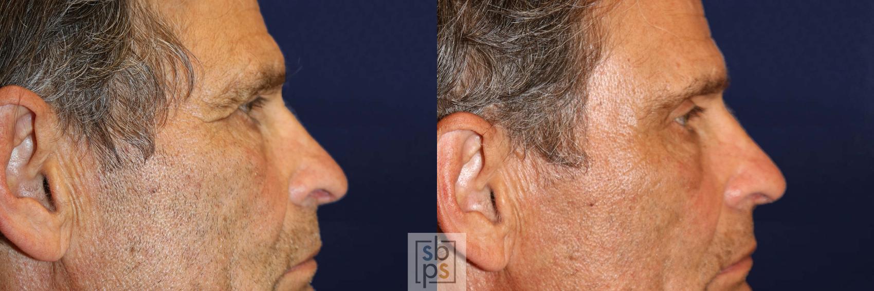 Before & After Brow Lift Case 570 Right Side View in Torrance & Los Angeles, CA, CA