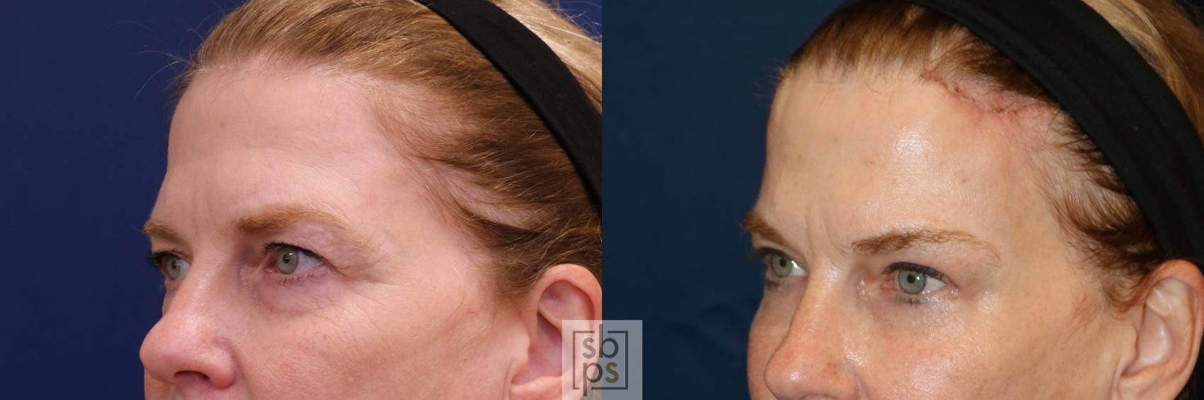 Before & After Brow Lift Case 650 Left Oblique View in Torrance & Los Angeles, CA, CA