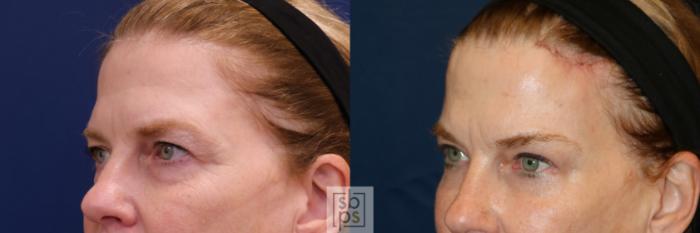 Before & After Brow Lift Case 650 Left Oblique View in Torrance, CA