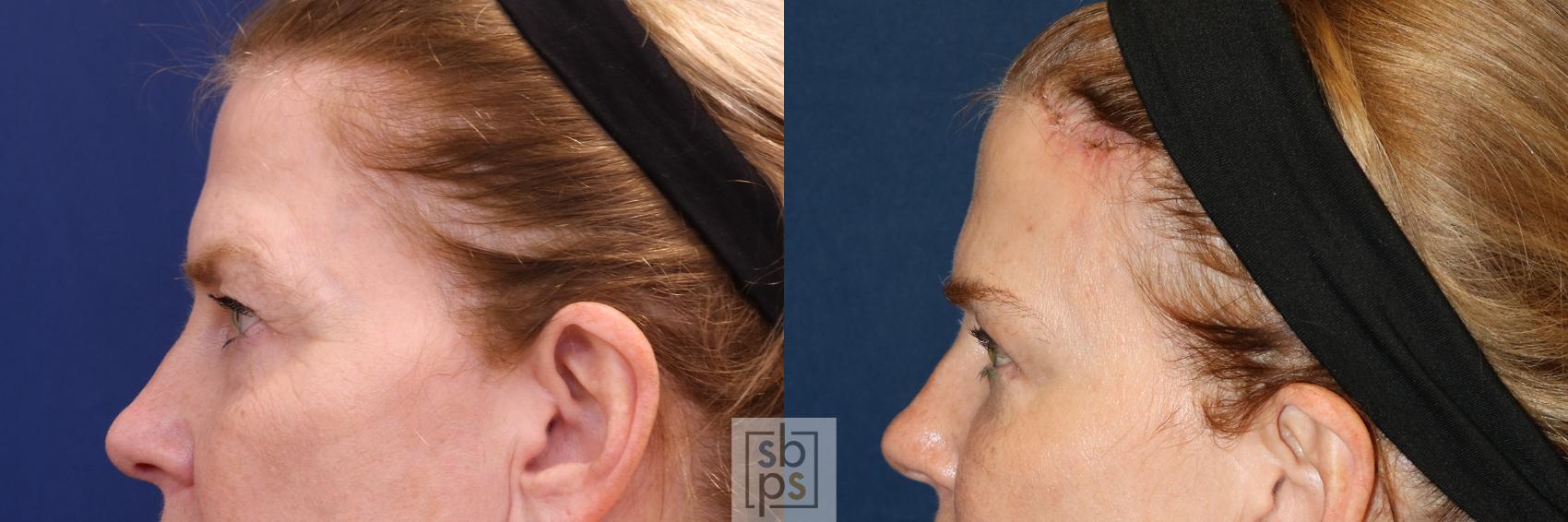 Before & After Brow Lift Case 650 Left Side View in Torrance & Los Angeles, CA, CA
