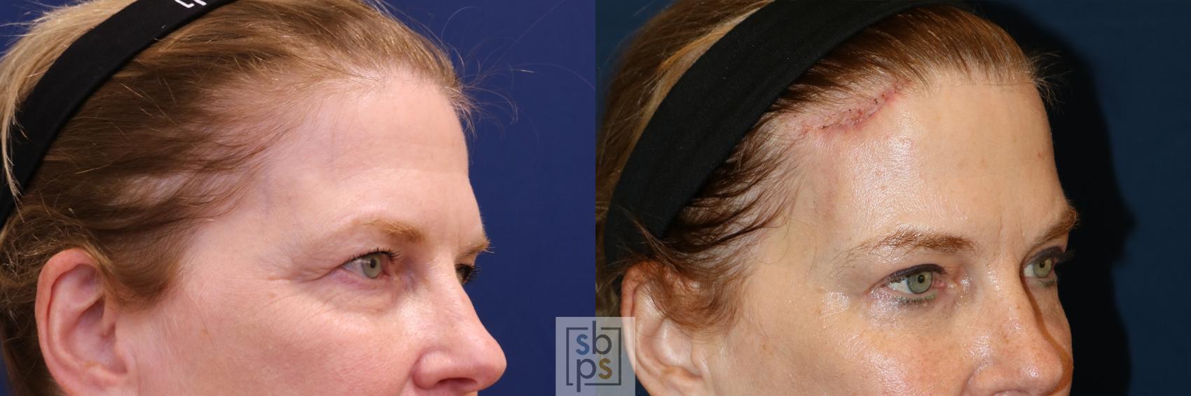 Before & After Brow Lift Case 650 Right Oblique View in Torrance & Los Angeles, CA, CA
