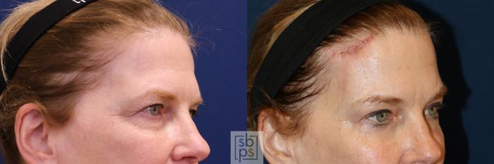 Before & After Brow Lift Case 650 Right Oblique View in Torrance, CA