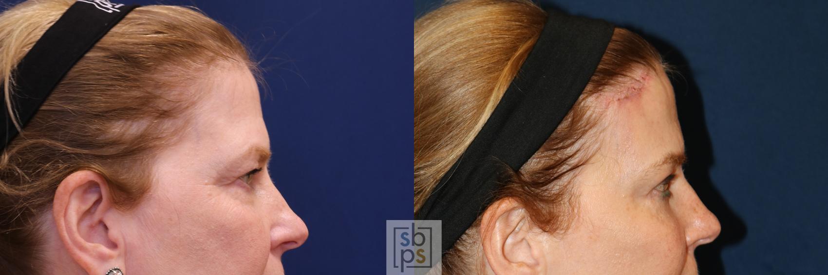Before & After Brow Lift Case 650 Right Side View in Torrance & Los Angeles, CA, CA
