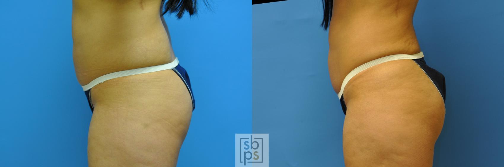 Before & After Buttock Augmentation Case 122 View #1 View in Torrance, CA