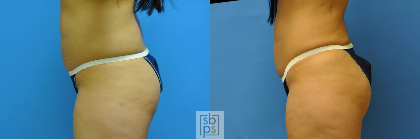 Brazilian Butt Lift (Fat Grafts to Buttocks) Before and After Pictures Case  585, Los Angeles, CA