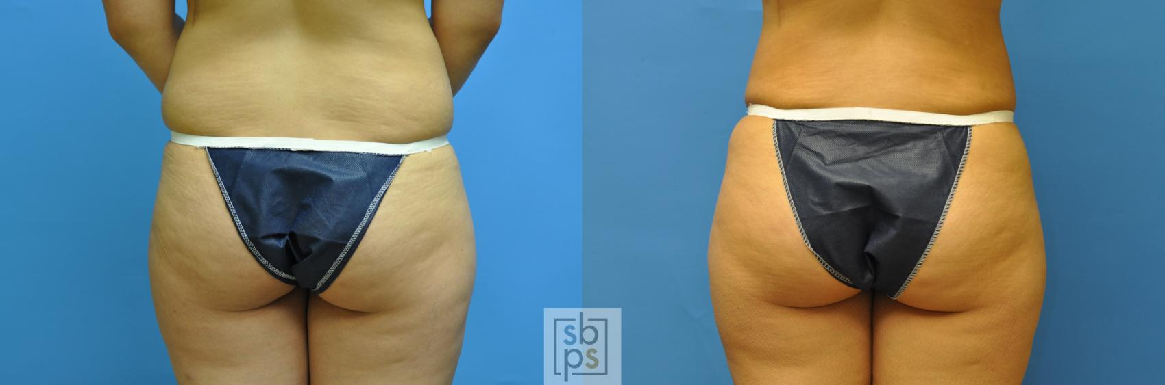 Before & After Buttock Augmentation Case 122 View #2 View in Torrance & Los Angeles, CA, CA