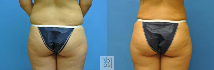 Before & After Fat Injection Case 122 View #2 View in Torrance, CA