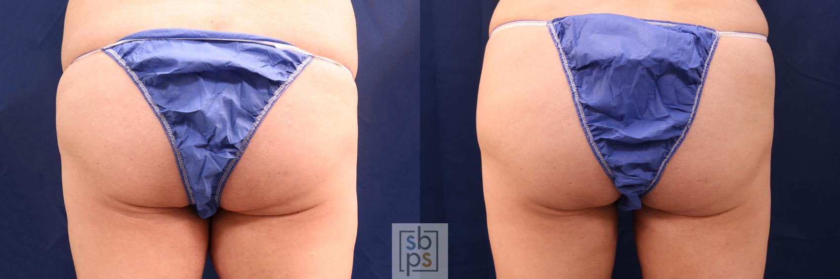 Before & After Buttock Augmentation Case 544 Back View in Torrance, CA
