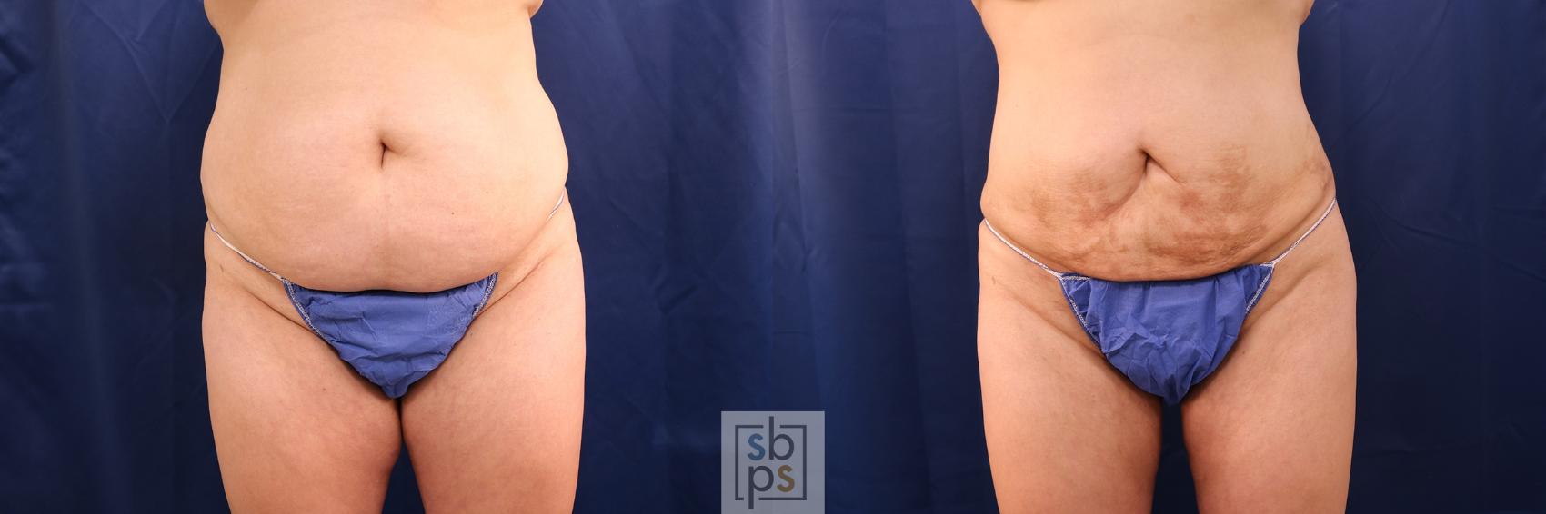 Before & After Buttock Augmentation Case 544 Front View in Torrance & Los Angeles, CA, CA