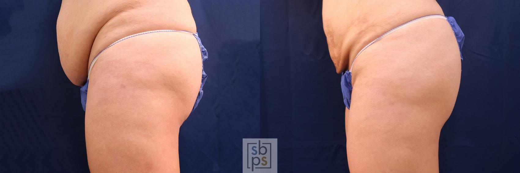 Before & After Buttock Augmentation Case 544 Left Side View in Torrance & Los Angeles, CA, CA
