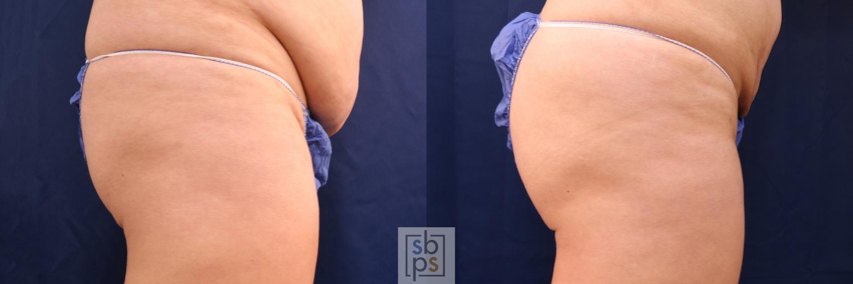Before & After Buttock Augmentation Case 544 Right Side View in Torrance & Los Angeles, CA, CA