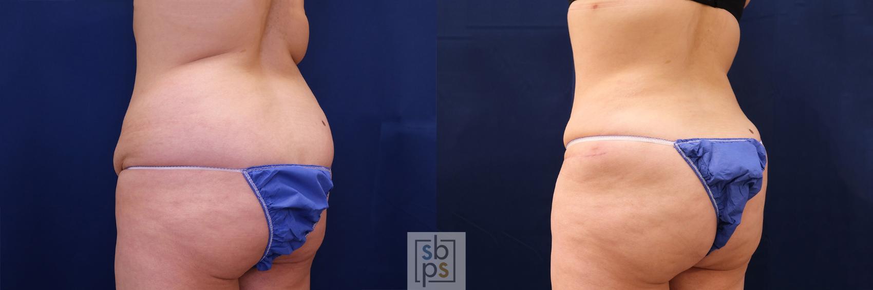 Before & After Buttock Augmentation Case 560 Back Right Oblique  View in Torrance & Los Angeles, CA, CA