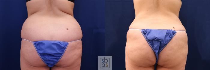 Before & After Buttock Augmentation Case 560 Back View in Torrance, CA