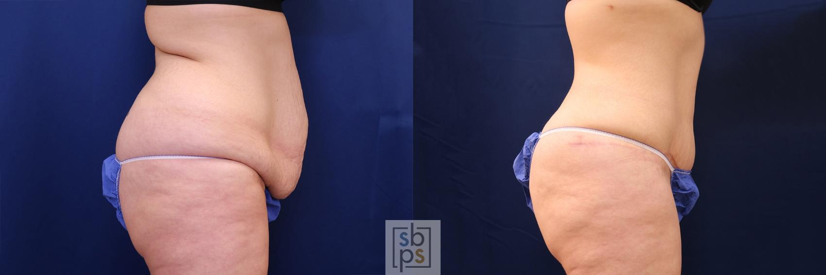 Before & After Buttock Augmentation Case 560 Left Side View in Torrance & Los Angeles, CA, CA