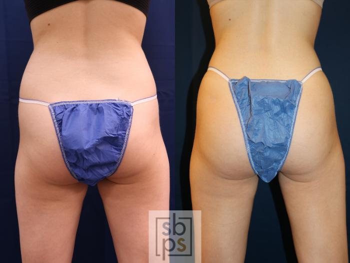 Before & After Buttock Augmentation Case 618 Back View in Torrance, CA
