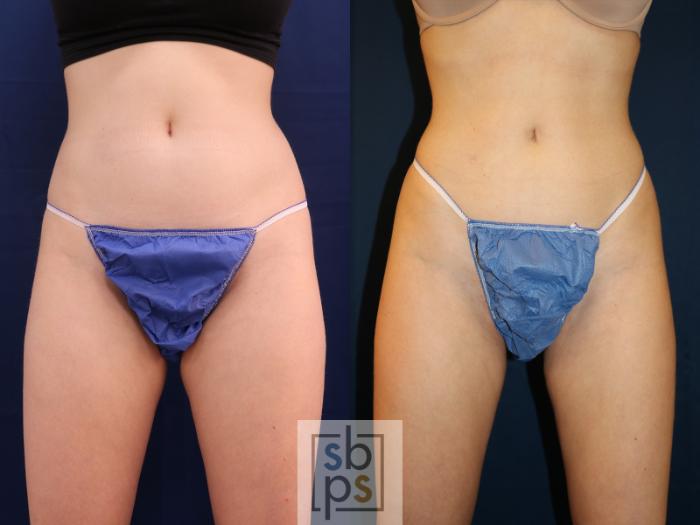 Before & After Liposuction Case 618 Front View in Torrance, CA