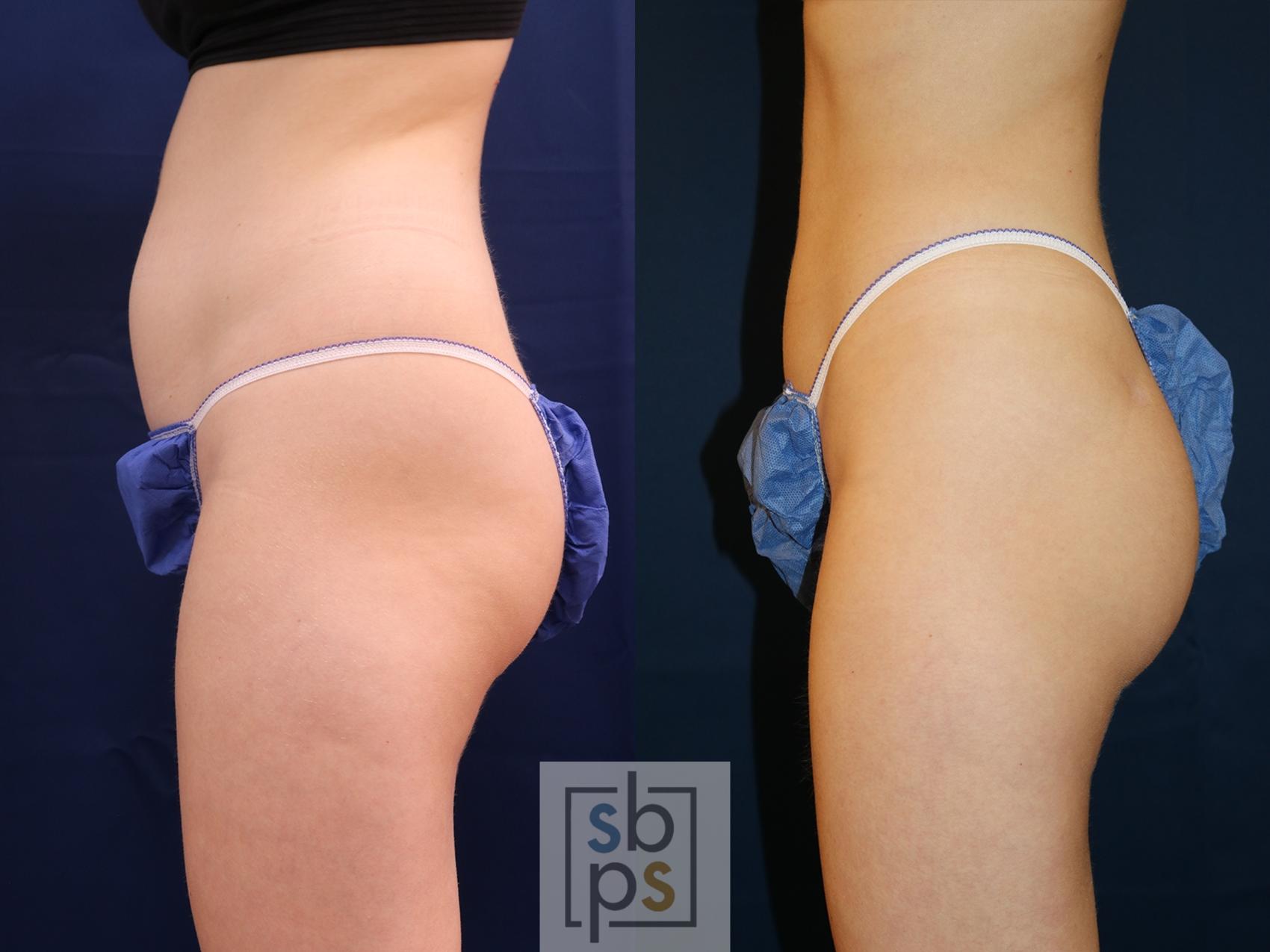 Before & After Liposuction Case 618 Left Oblique View in Torrance & Los Angeles, CA, CA