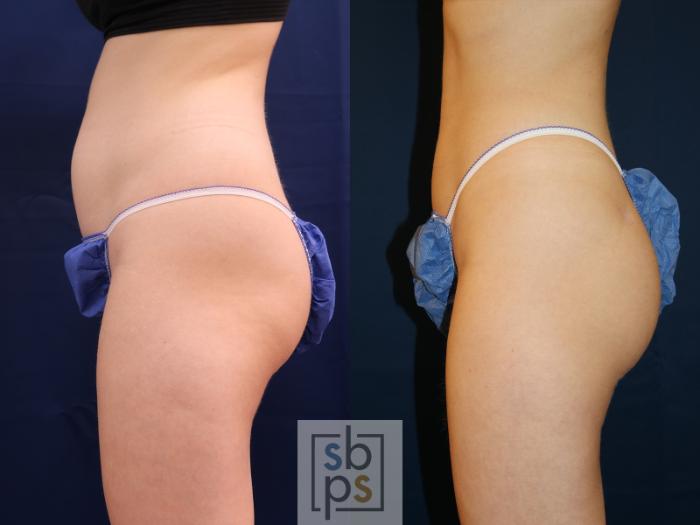 Before & After Buttock Augmentation Case 618 Left Oblique View in Torrance, CA
