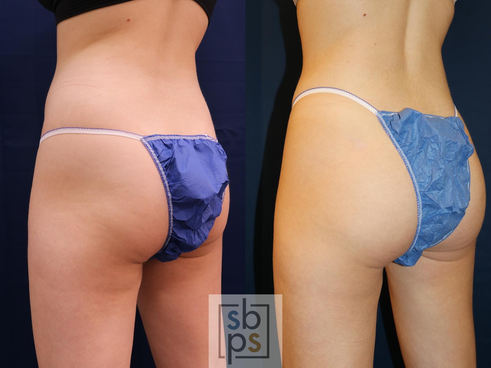 Before & After Liposuction Case 618 Left Side View in Torrance & Los Angeles, CA, CA