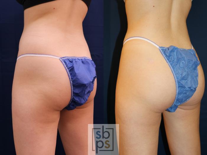 Before & After Buttock Augmentation Case 618 Left Side View in Torrance, CA