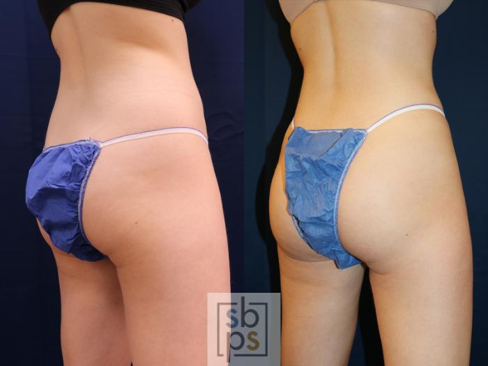 Before & After Buttock Augmentation Case 618 Right Oblique View in Torrance, CA