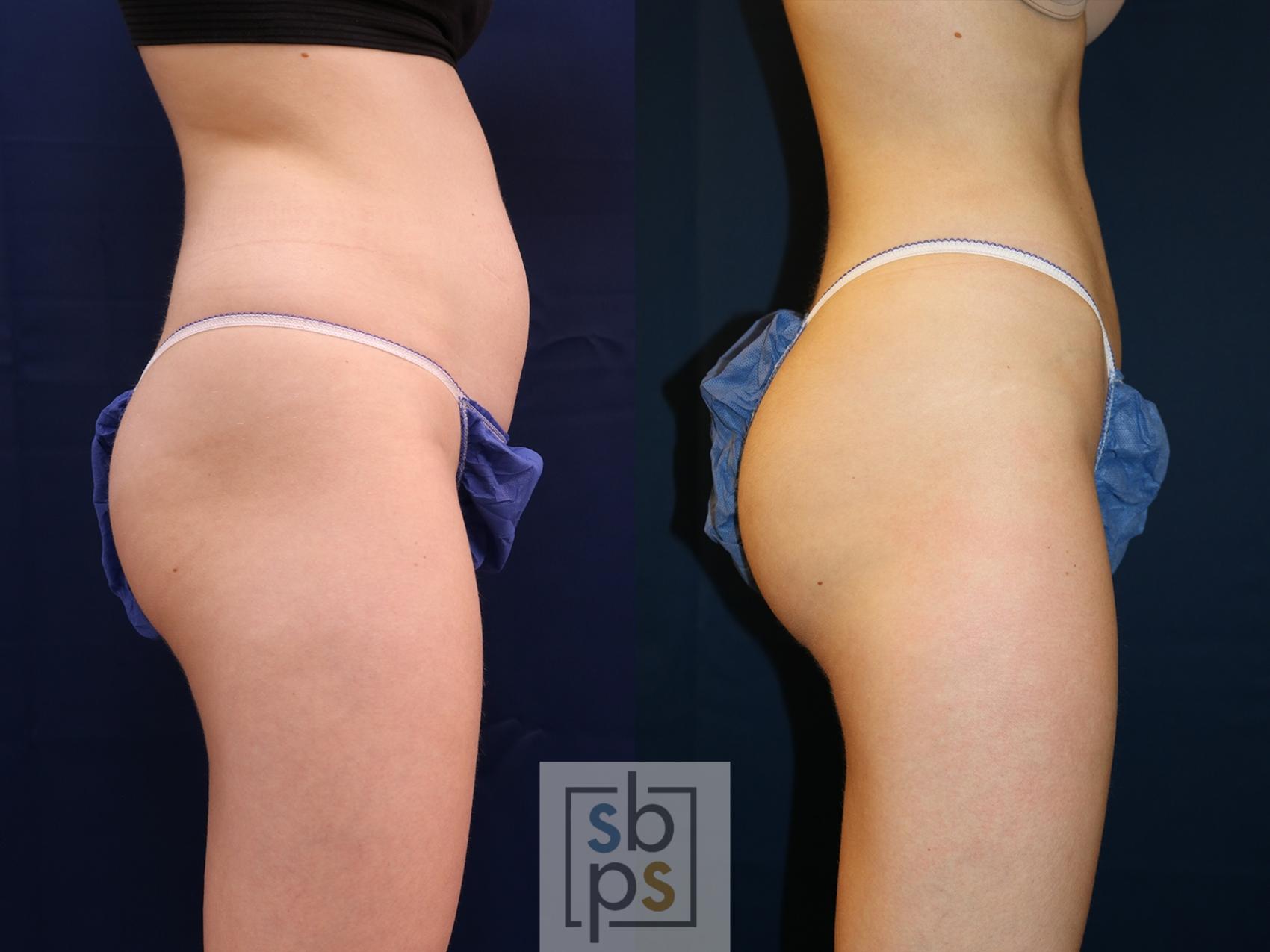 Before & After Liposuction Case 618 Right Side View in Torrance & Los Angeles, CA, CA