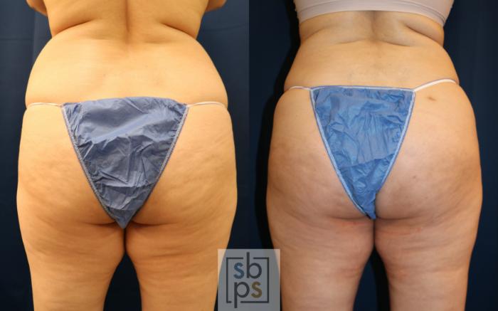 Before & After Buttock Augmentation Case 687 Back View in Torrance, CA
