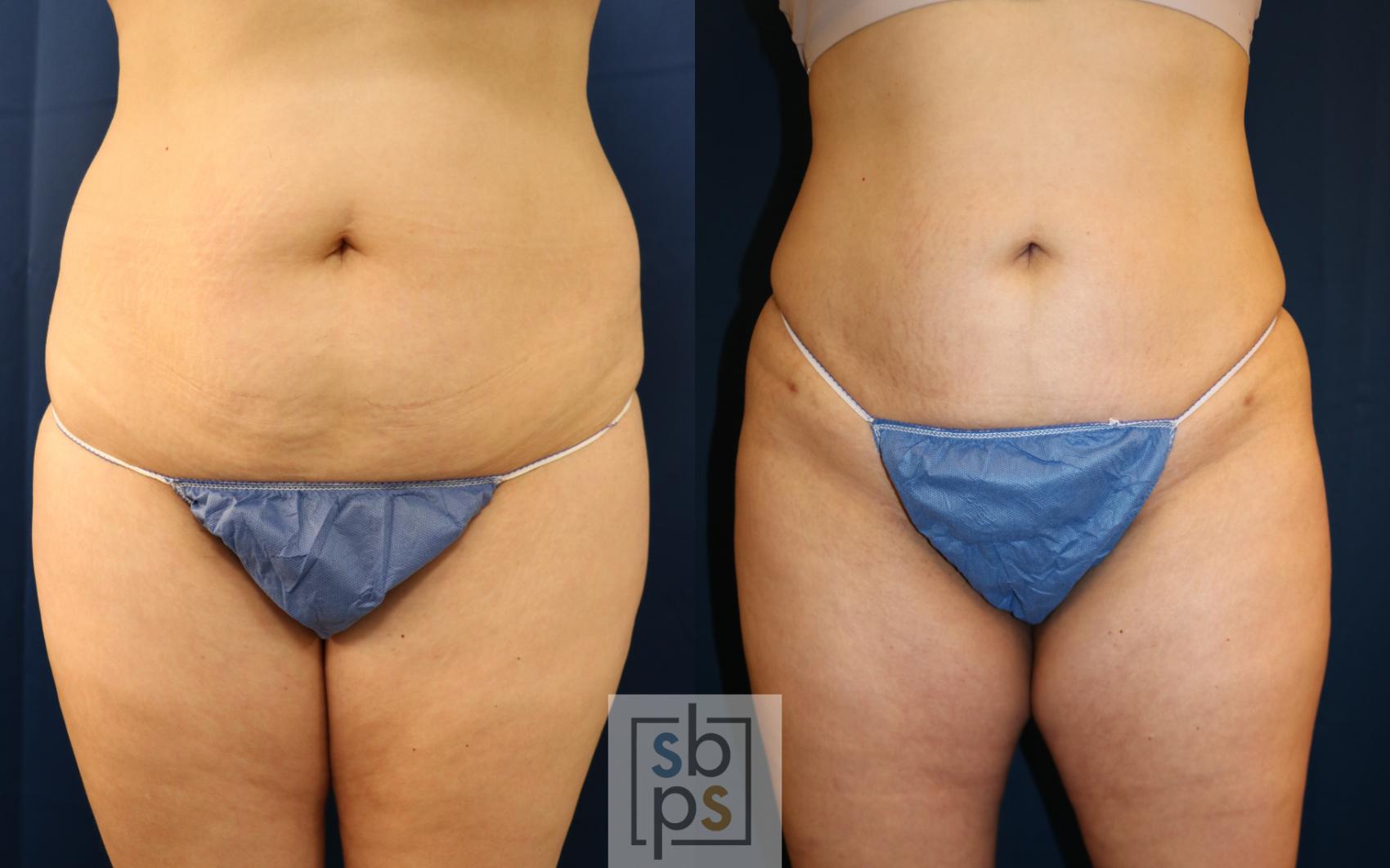 Before & After Liposuction Case 687 Front View in Torrance & Los Angeles, CA, CA