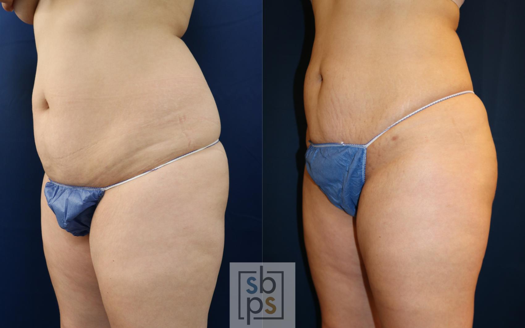 Before & After Liposuction Case 687 Left Oblique View in Torrance & Los Angeles, CA, CA