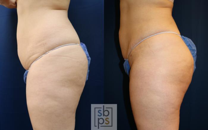 Before & After Buttock Augmentation Case 687 Left Side View in Torrance, CA