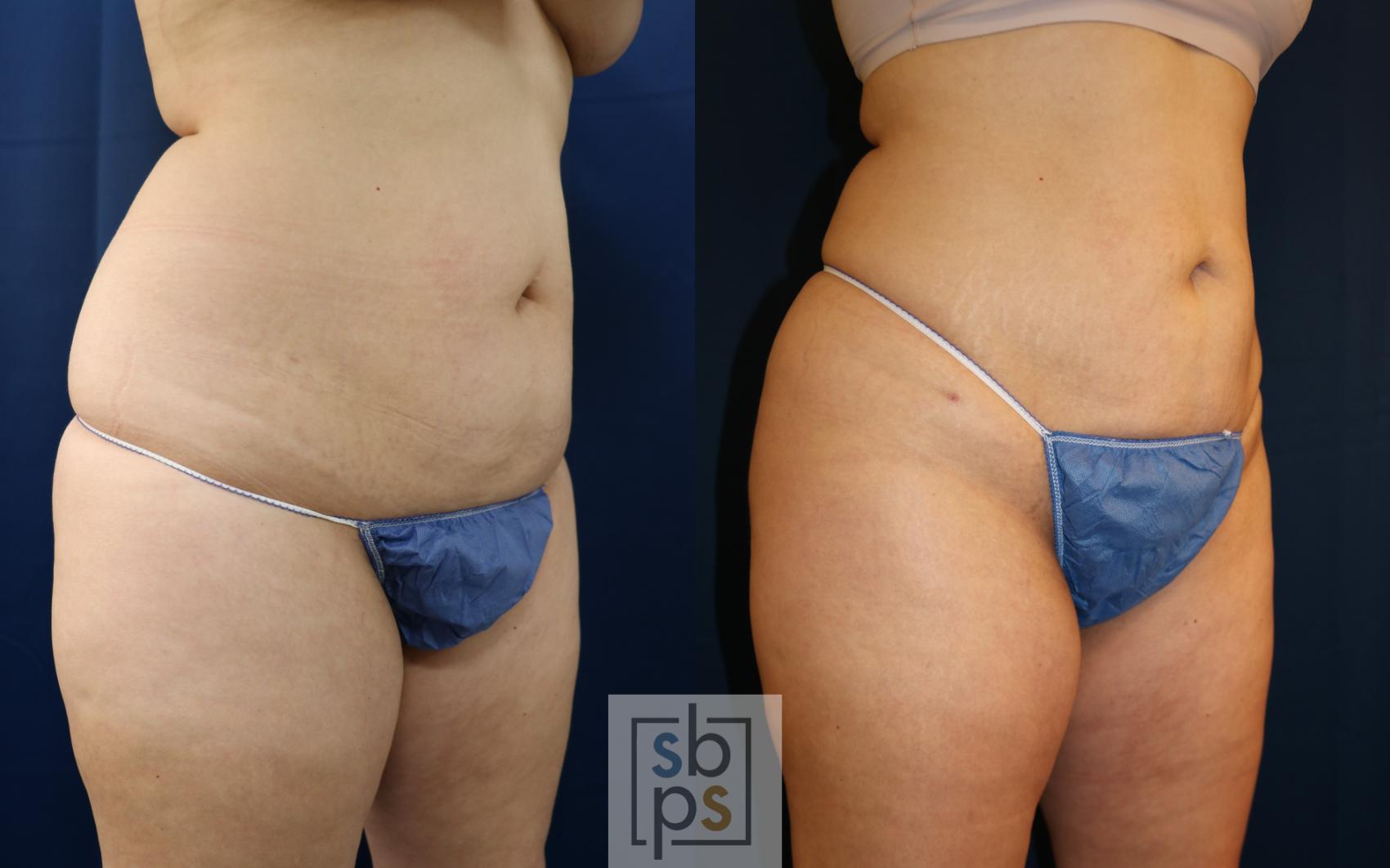Before & After Liposuction Case 687 Right Oblique View in Torrance & Los Angeles, CA, CA