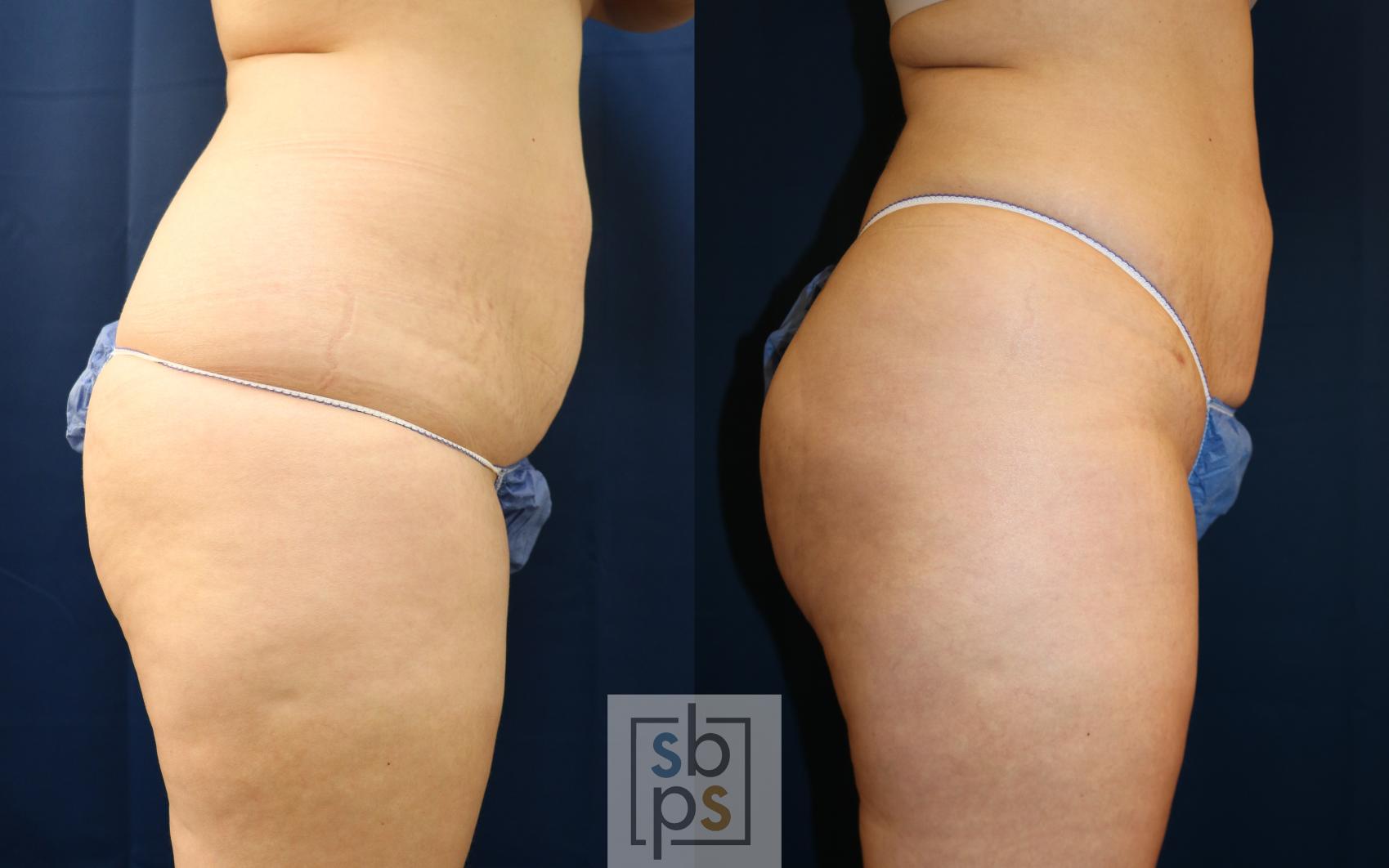 Before & After Liposuction Case 687 Right Side View in Torrance & Los Angeles, CA, CA