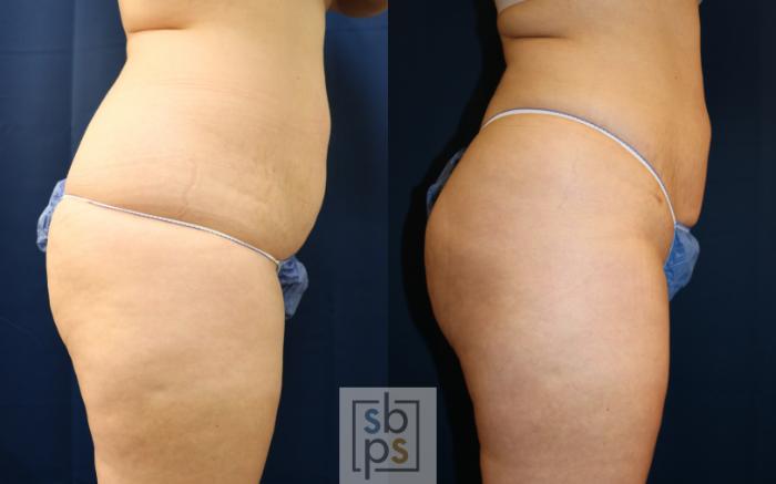 Before & After Buttock Augmentation Case 687 Right Side View in Torrance, CA