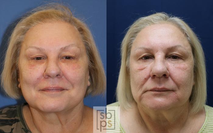 Before & After Chemical Peels Case 489 Front View in Torrance, CA
