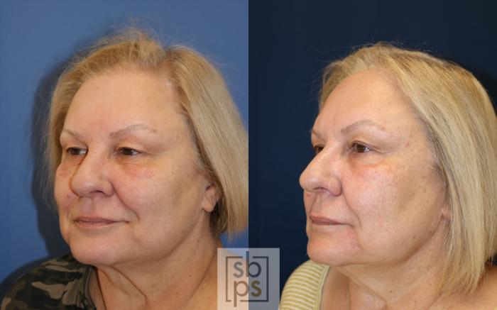 Before & After Chemical Peels Case 489 Left Oblique View in Torrance, CA