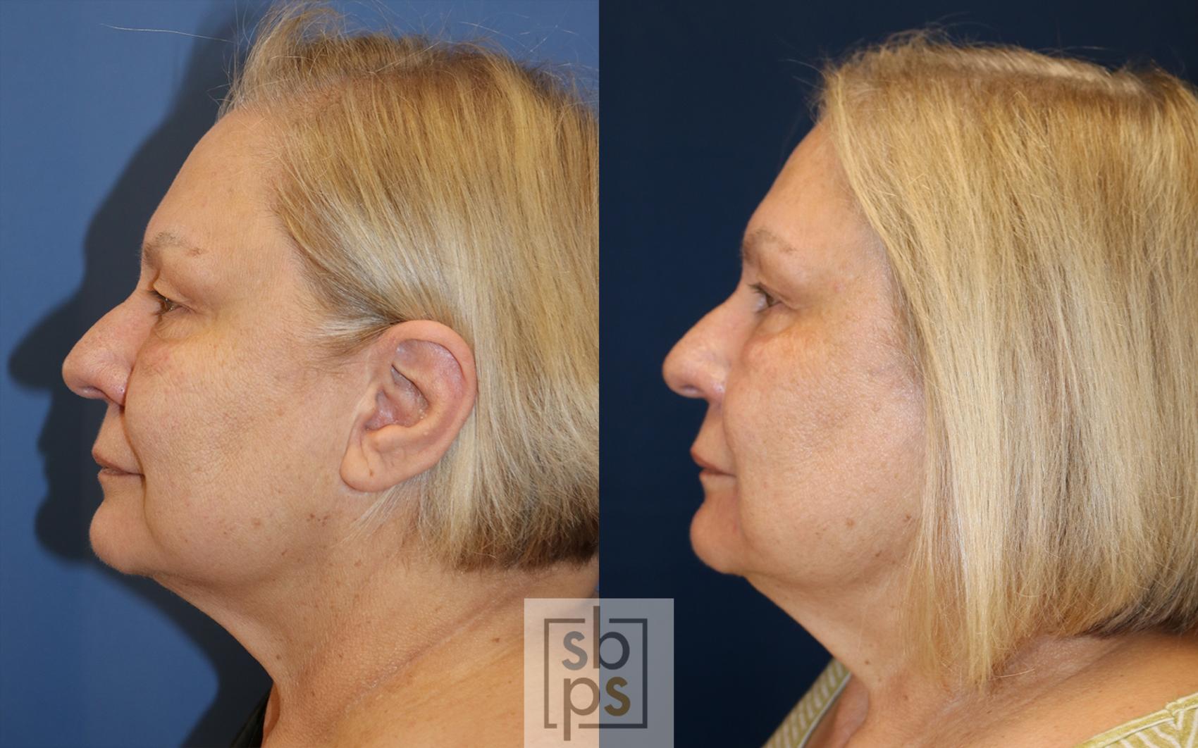 Before & After Chemical Peels Case 489 Left Side View in Torrance & Los Angeles, CA, CA
