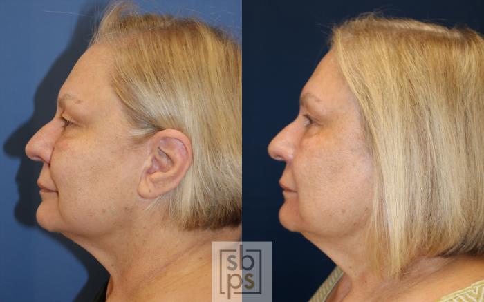 Before & After Chemical Peels Case 489 Left Side View in Torrance, CA